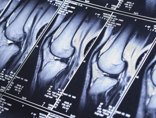 Rezonans magnetyczny kolana – wskazania, przebieg i korzyści badania MRI stawu kolanowego