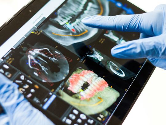 Wszczepienie implantu zęba - czy warto?