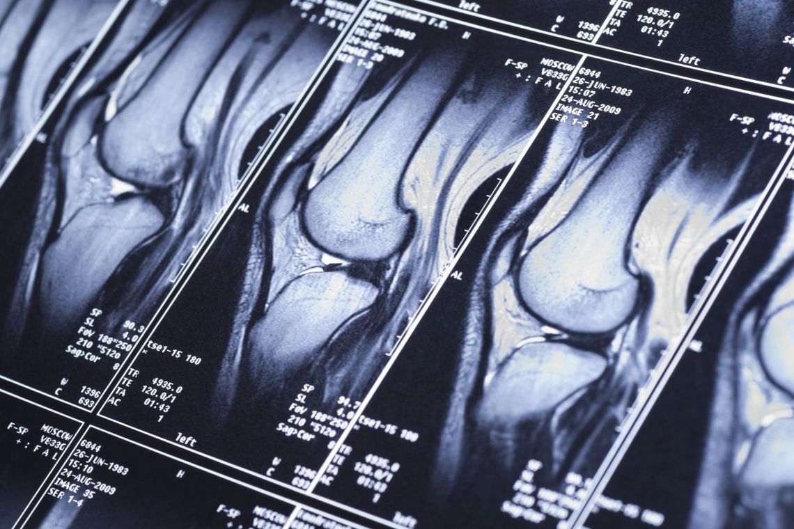 Rezonans magnetyczny kolana – wskazania, przebieg i korzyści badania MRI stawu kolanowego